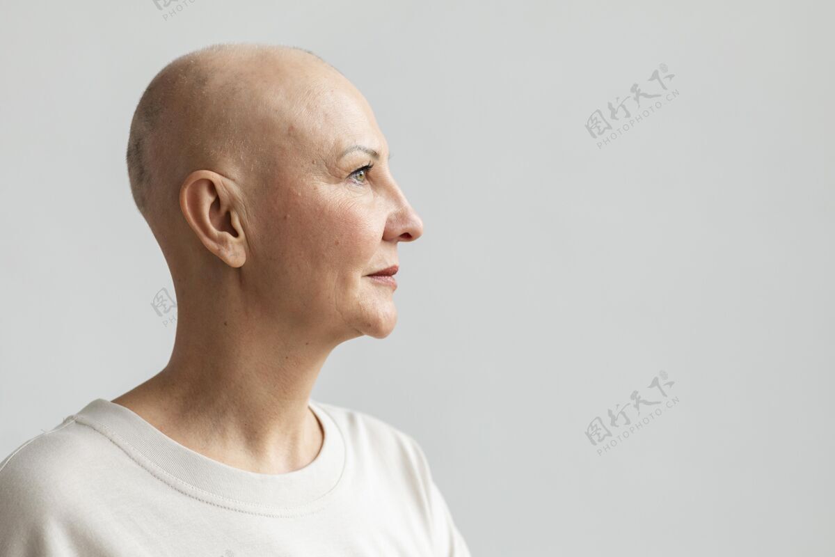 战斗有复制空间的皮肤癌女人秃头女人疾病